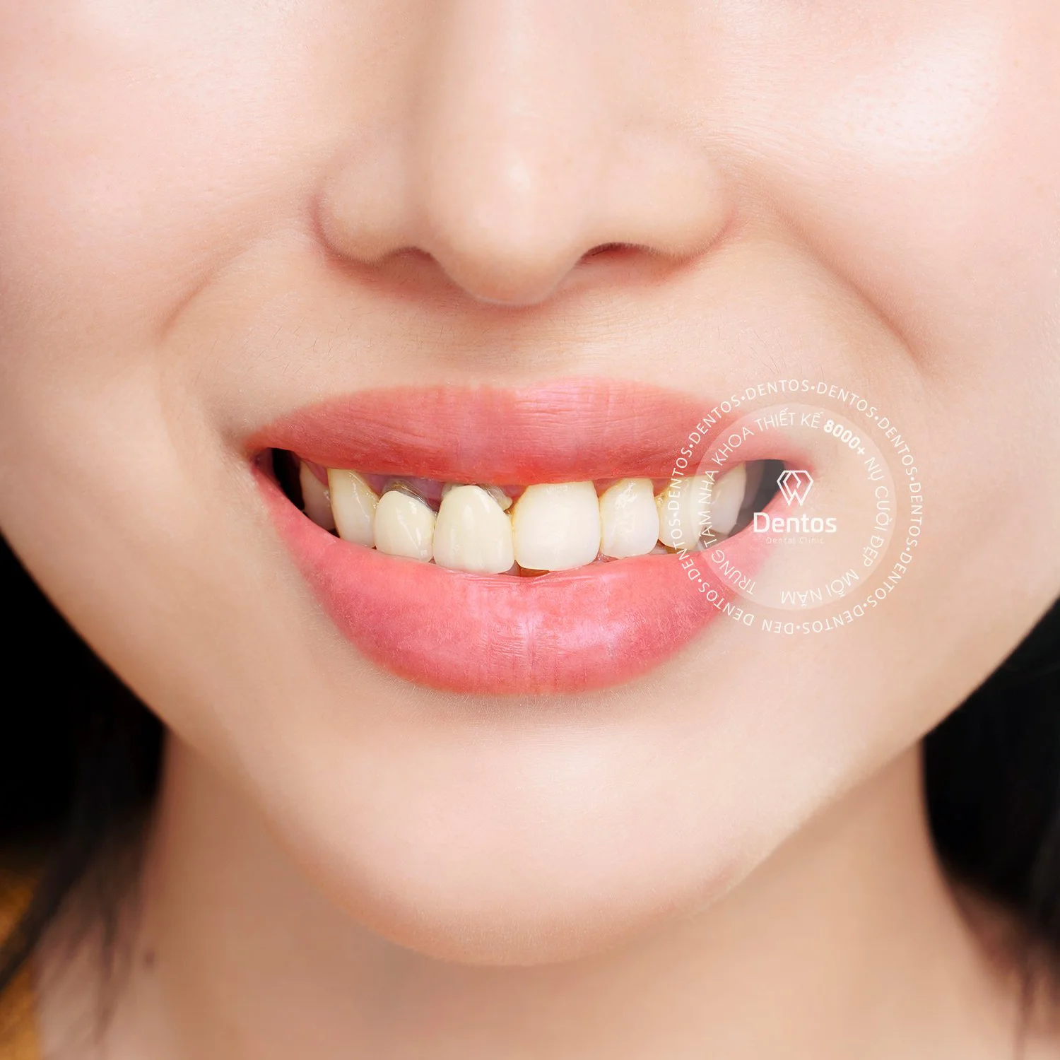 Kỹ thuật mài răng kém và lấy dấu không chính xác gây hở viền răng